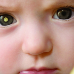 Đục thủy tinh thể ở trẻ em là gì?