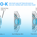 Điều trị cận thị bằng kính áp tròng chỉnh hình giác mạc Ortho-K