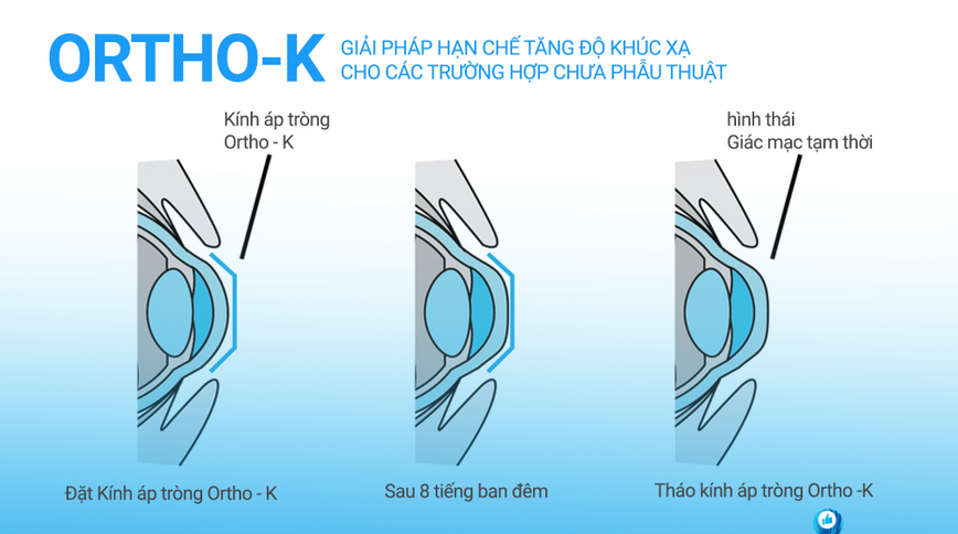 Điều trị cận thị bằng kính áp tròng chỉnh hình giác mạc Ortho-K -Kính mắt  Việt Hàn